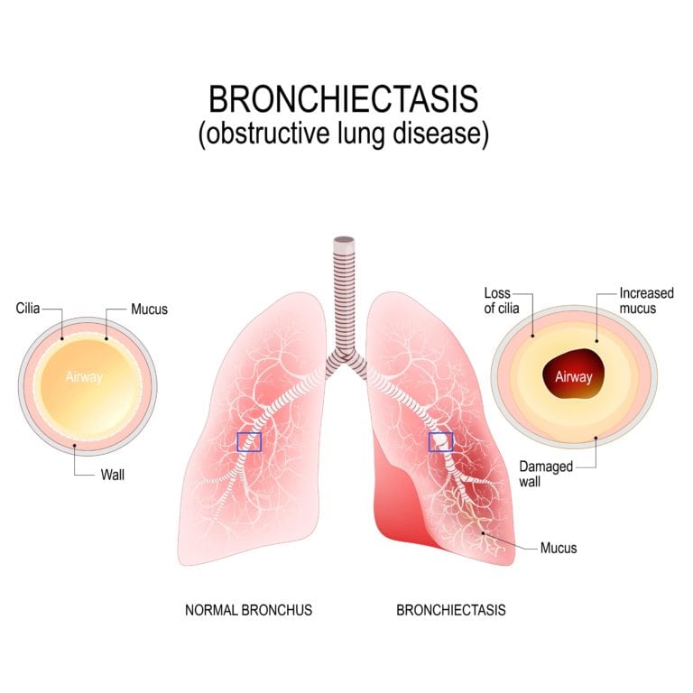 Treatment of Bronchiectasis