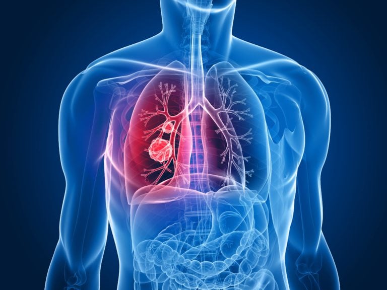 Lung Conditions