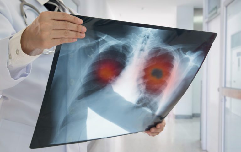 Lung Cancer Screen