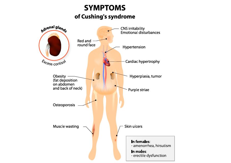 Illustration of male body with symptoms of Cushing's syndrome