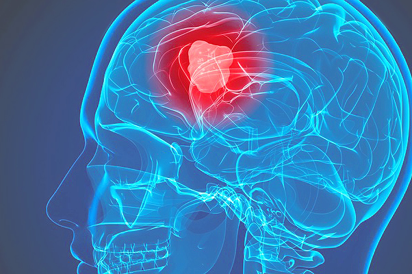 Dr. Santosh Kesari, Principal Investigator, Oversees Open Neurological & Brain Cancer Clinical Trials