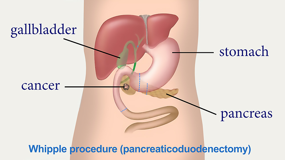 Whipple procedure diagram - Saint John's Cancer Institute
