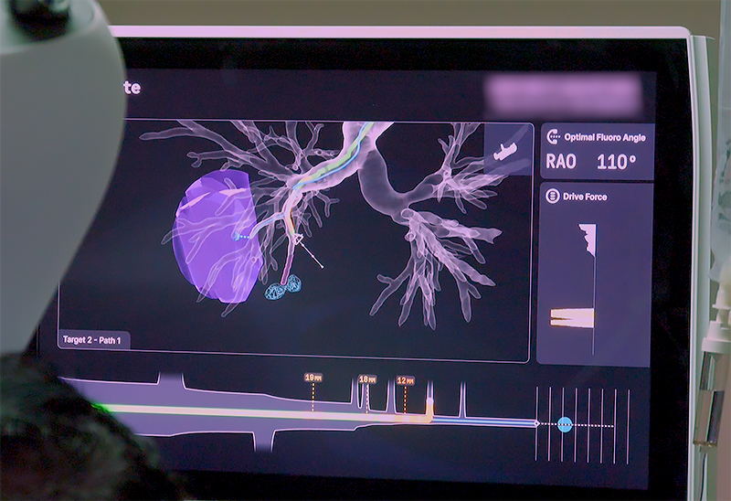 Ion robotic bronchoscopy at Saint John's
