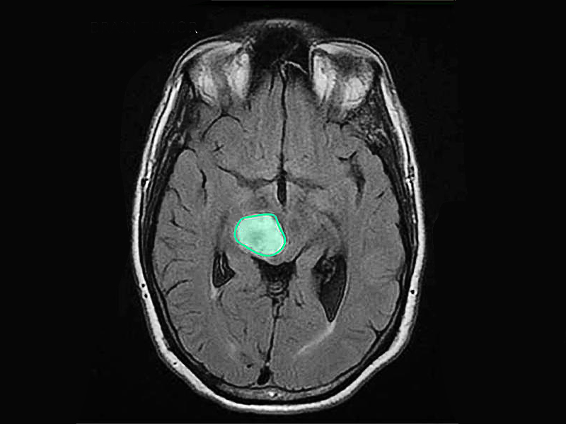 Diffuse midline glioma
