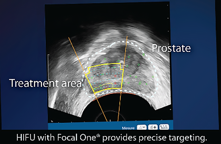 Focal One Therapy - Precise prostate targeting of the treatment area