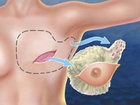 Modified Radical Mastectomy illustration