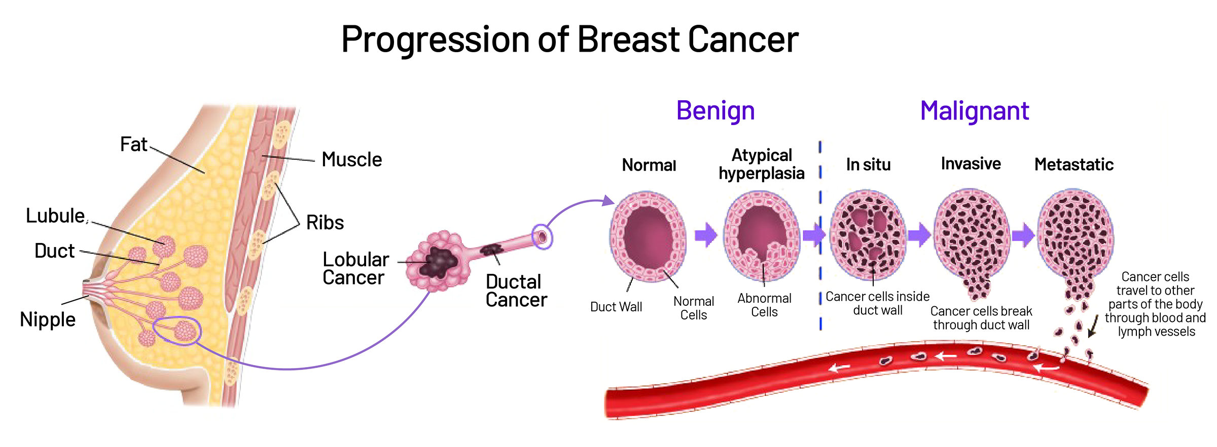 Types of Breast Cancer  Saint John's Cancer Institute