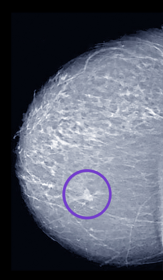 Invasive Lobular Carcinoma