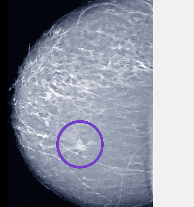 Mammogram - Breast Cancer - Saint John's Cancer Institute