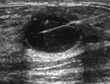 core-needle biopsy - breast cancer