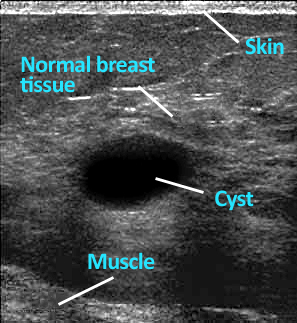 A cyst is revealved on a mammogram