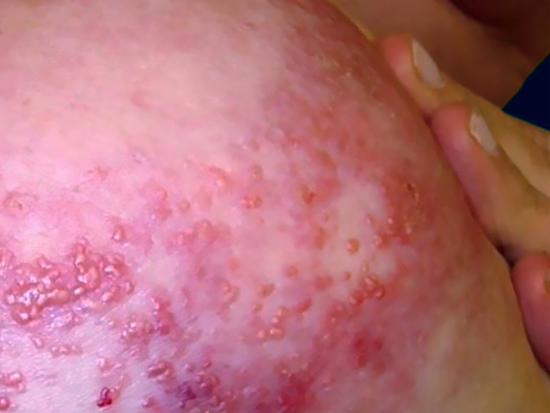 Inflammatory breast cancer