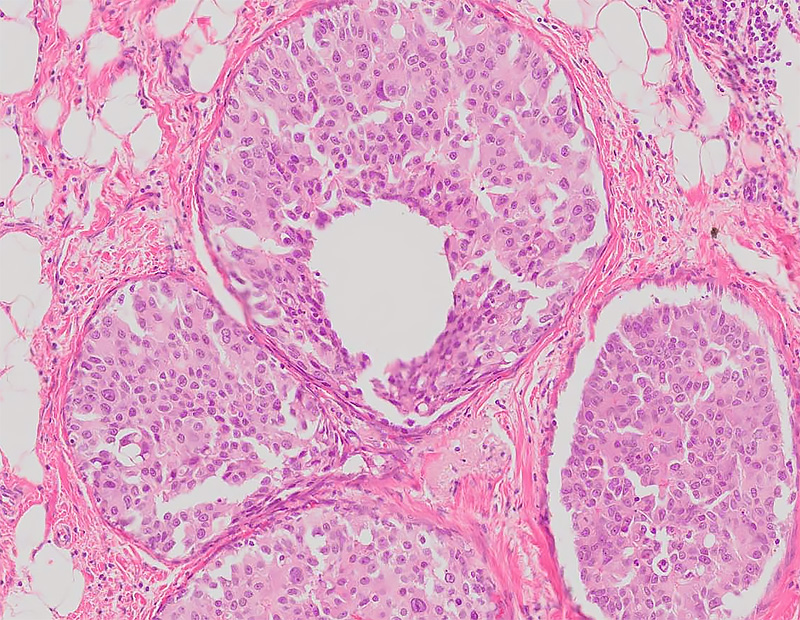 Histology - Breast Cancer - Saint John's Cancer Institute