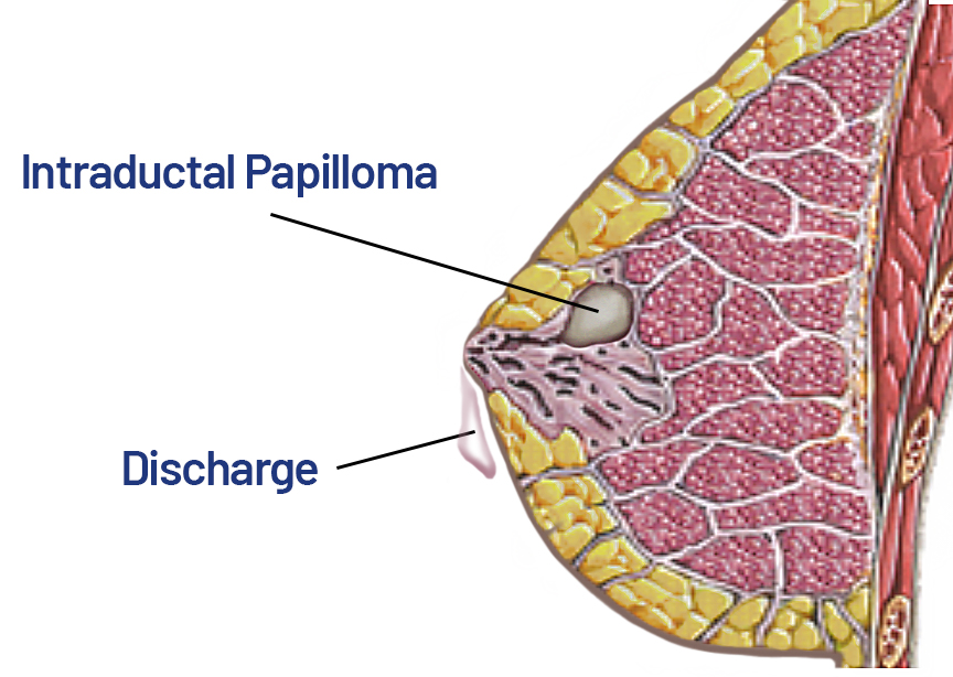 Intradutal papilloma - Saint John's Cancer Institure