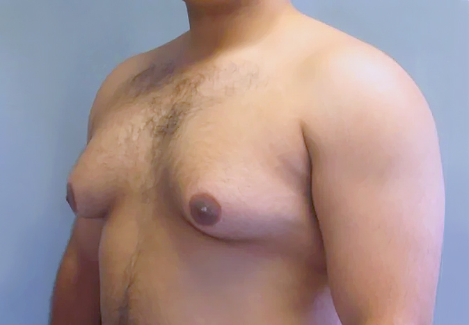 Male Breast Conditions - Gynecomastia - Margie Petersen Breast Center