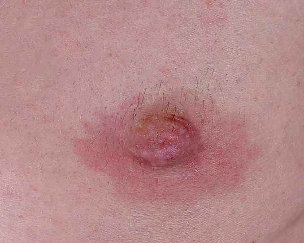 Male Breast Conditions - Mastitis - Margie Petersen Breast Center
