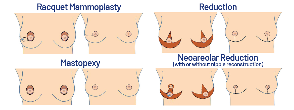 Oncoplastic Breast Surgery - Saint John's Health Center