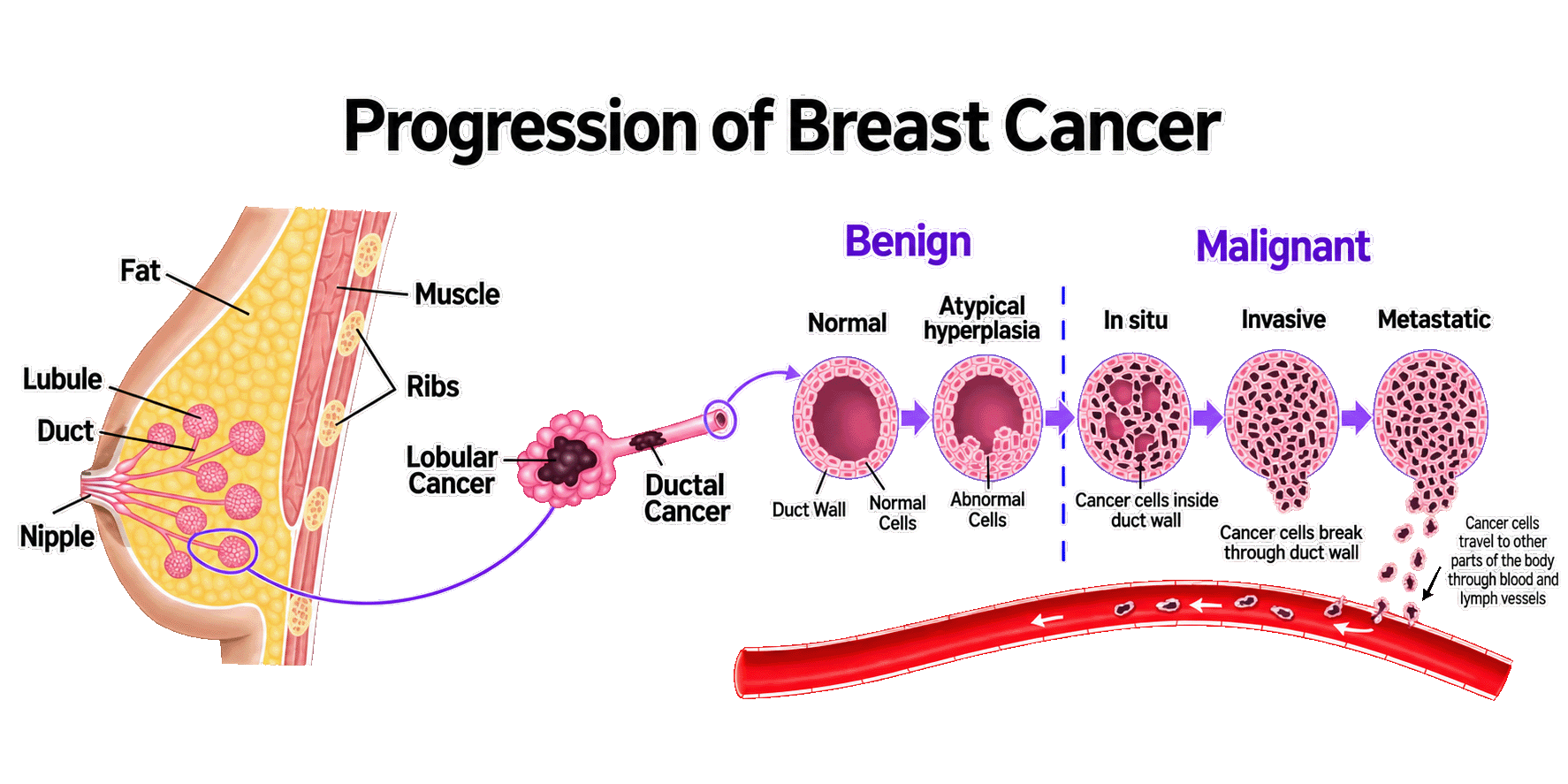 Breast Cancer Progression - Saint John's Cancer Institute