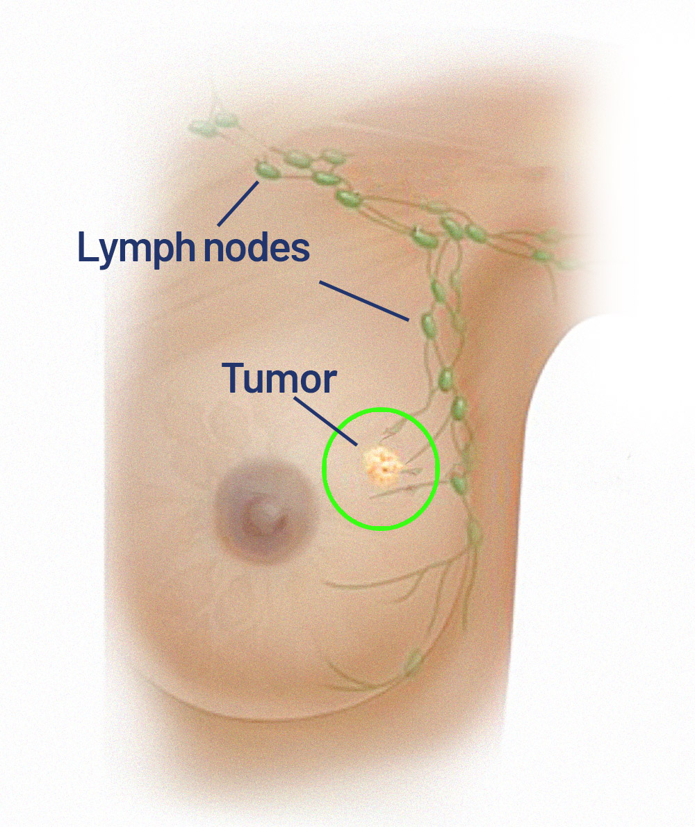 Breast cancer and lymph nodes