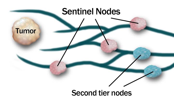 Breast Cancer - Sentinel node biopsy