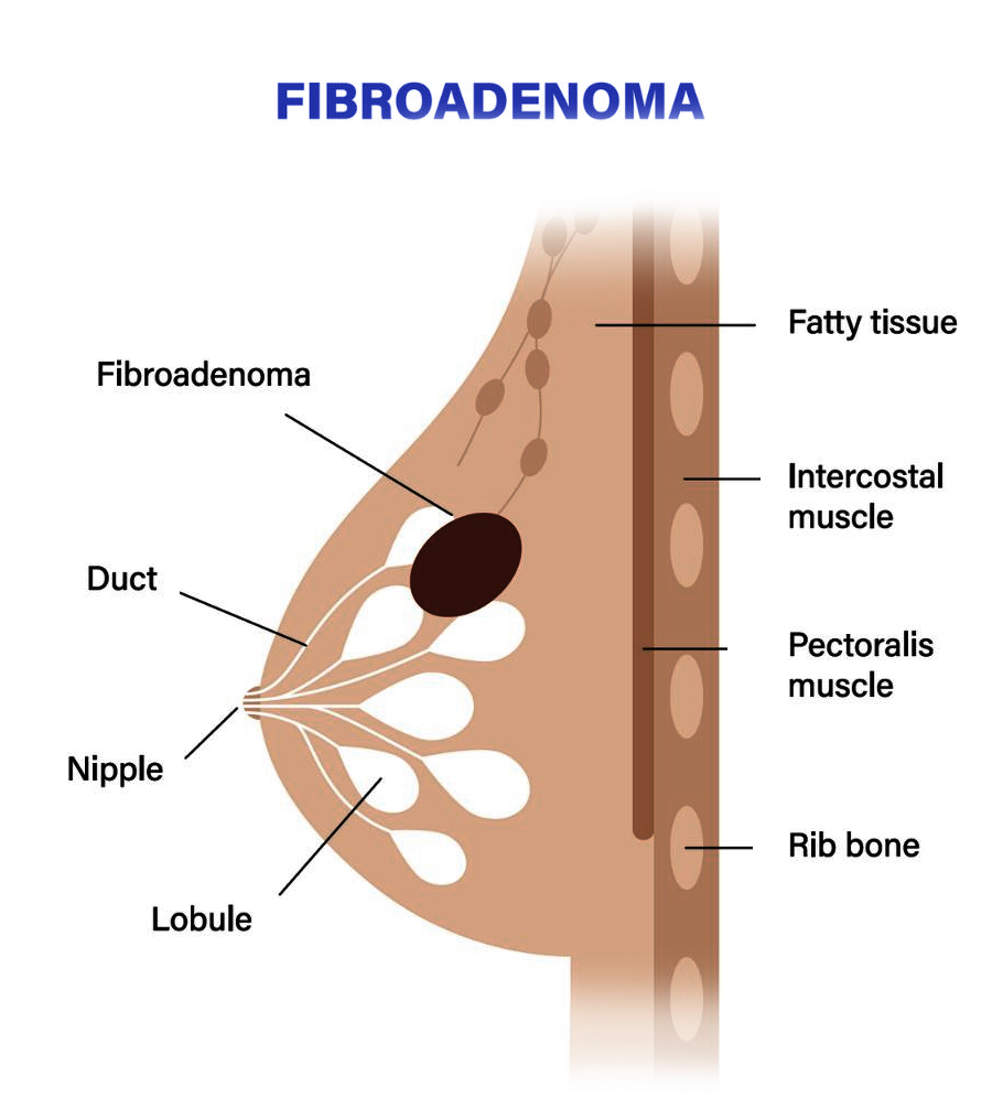 Fibroadenoma - Saint John's Cancer Institute