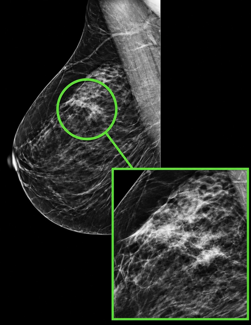 High-risk-breast-lesion-mammogram