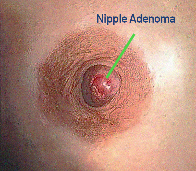 Nipple adenoma