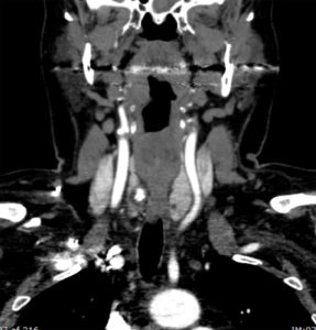 Patient with recurrent hyperparathyroidism Previously had 3 glands removed 1