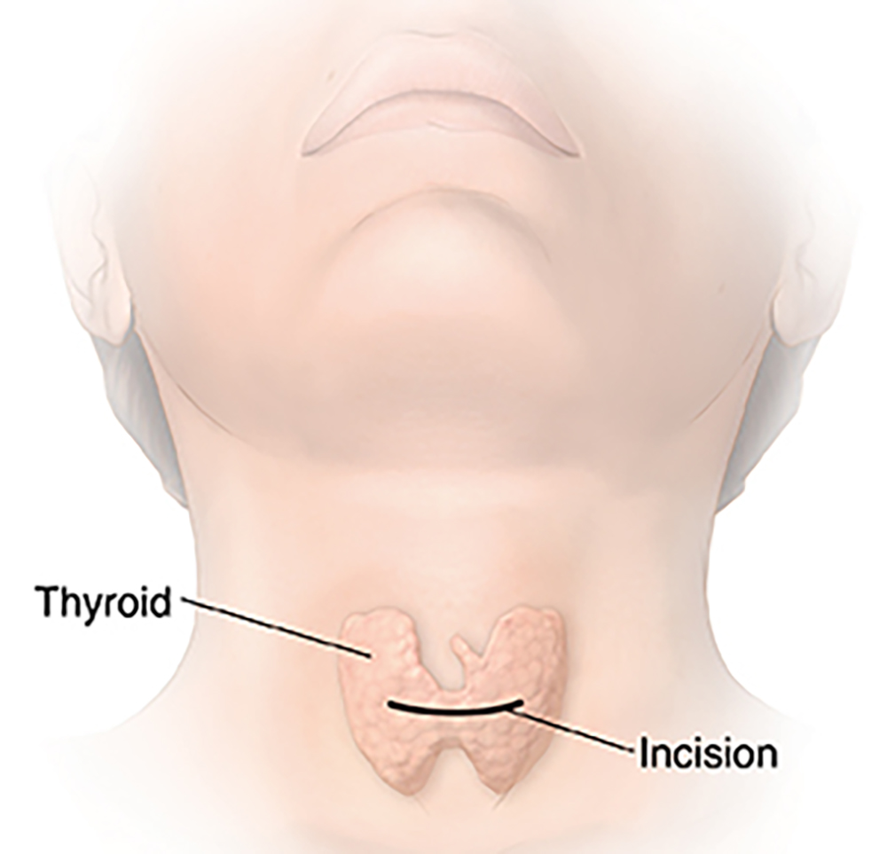Thyroidectomy (Thyroid Surgery) Total and Lobectomy Saint John’s