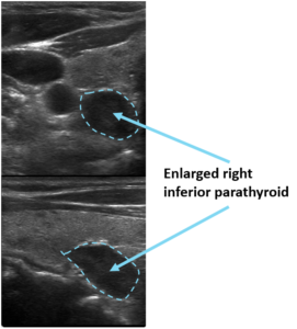 Enlarged right inferior parathyroid