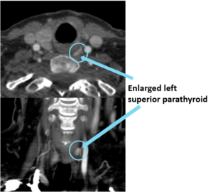 Enlarged left superior parathyroid imaging