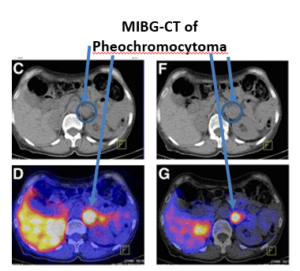 MIBG-CT of Pheochromocytoma