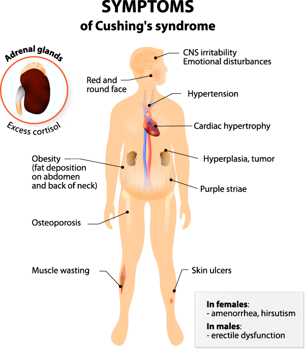 case study 77 cushing syndrome