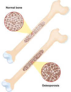 Osteoporosis. disease of bones