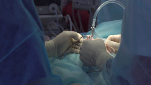 Operation using laparoscopic equipment. Surgeons team. Hospital