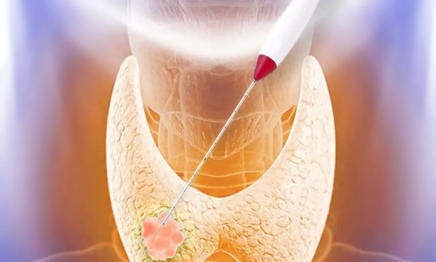 Thyroid Radiofrequency Ablation - Saint Johns Cancer Institute