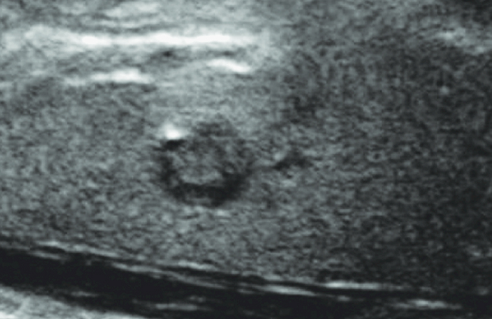 Papillary Thyroid Cancer (PTC)