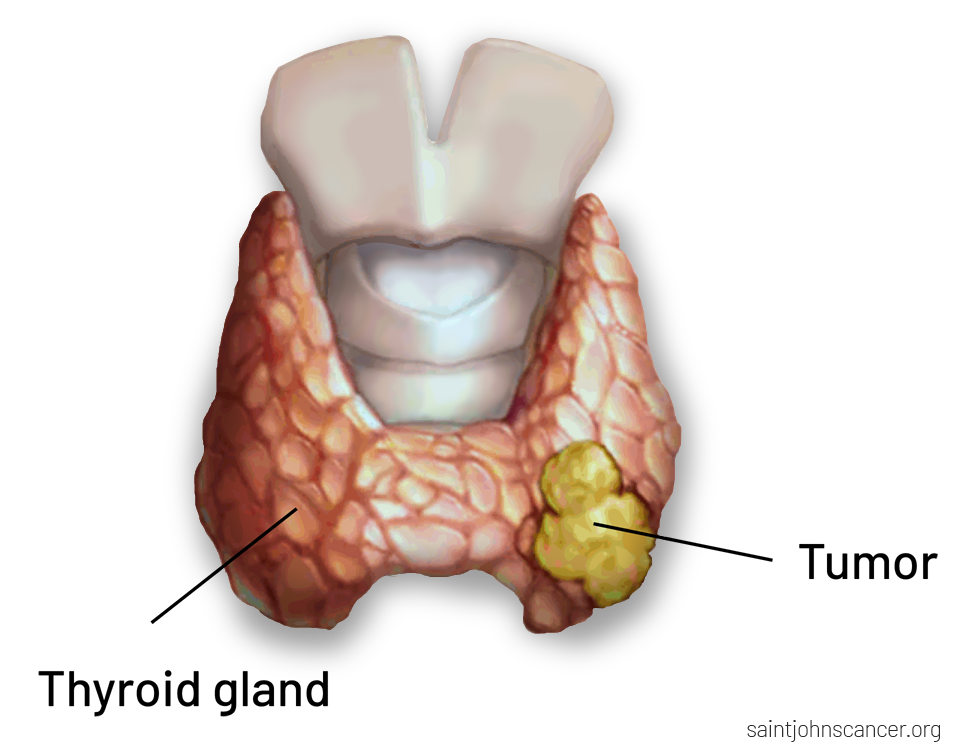 research topics thyroid cancer