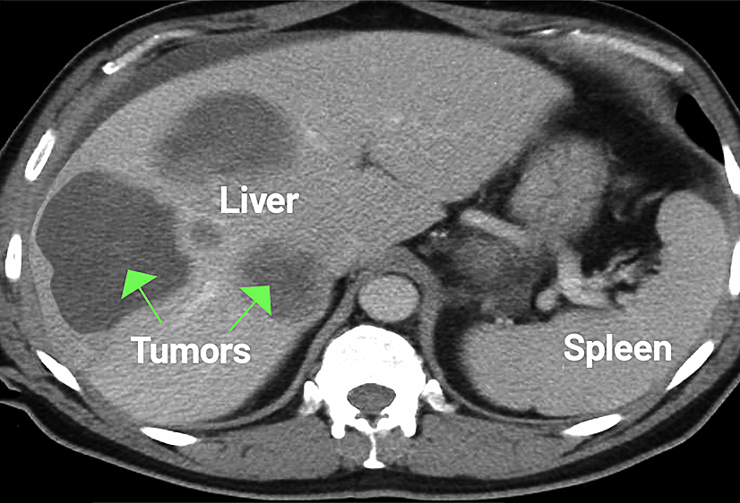 Adrenal Cancer and metastasis