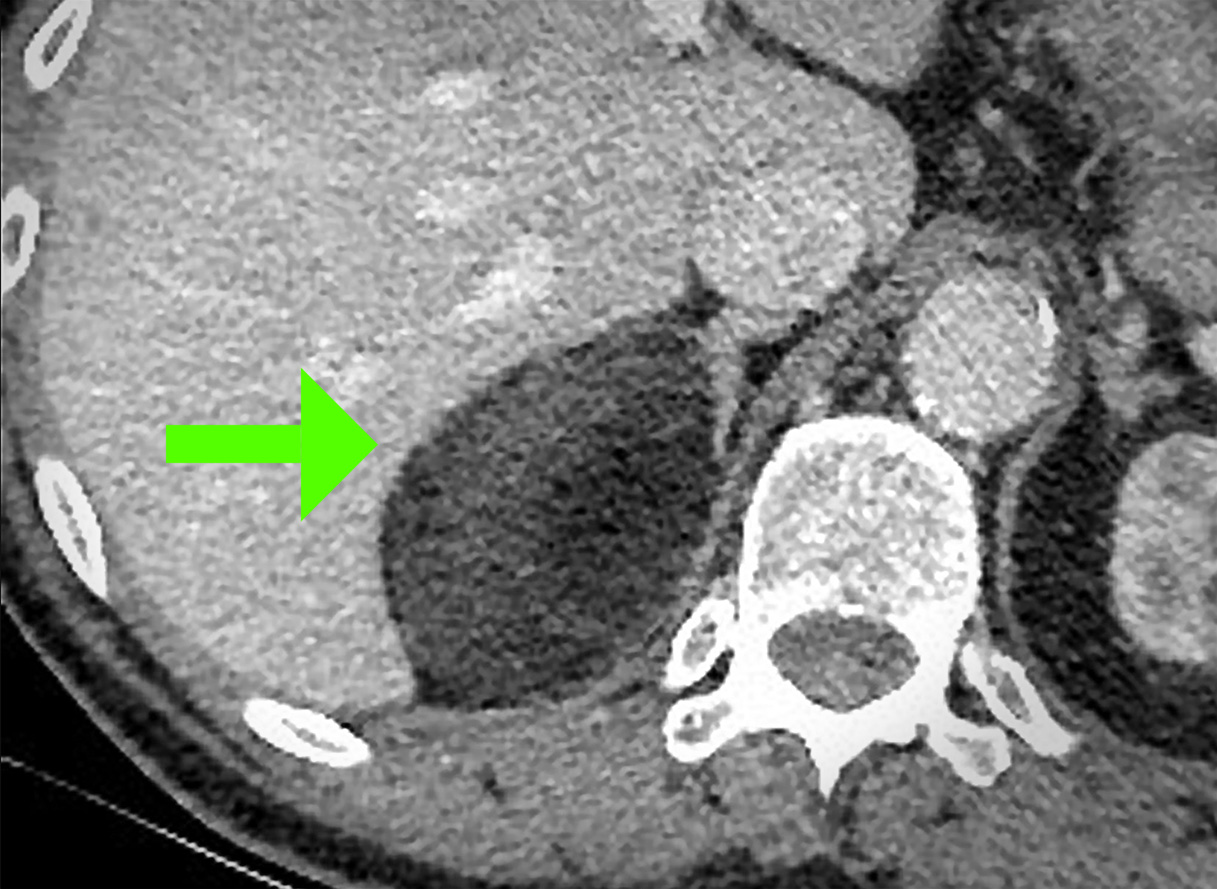 Adrenal-protocol CT scan - Cushing's Syndrome