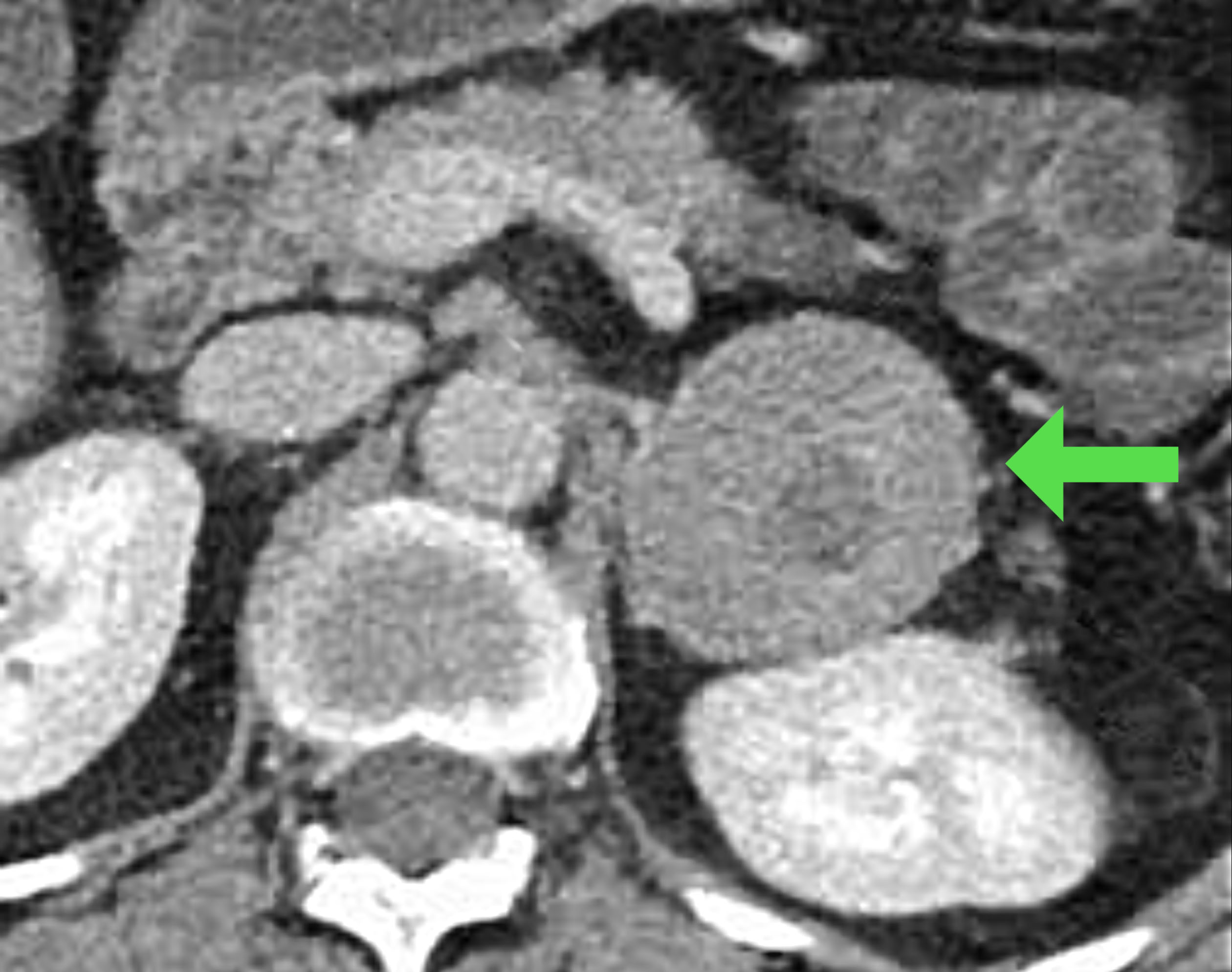 Adrenocortical carcinoma - Saint John's Cancer Institute