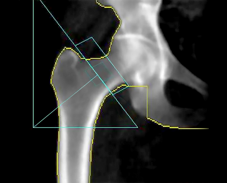 Bone Density (DEXA) Scan of the hip and spine