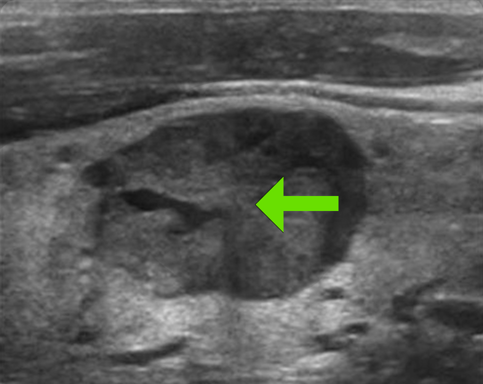 Medullary thyroid cancer - Saint John's Cancer Institute