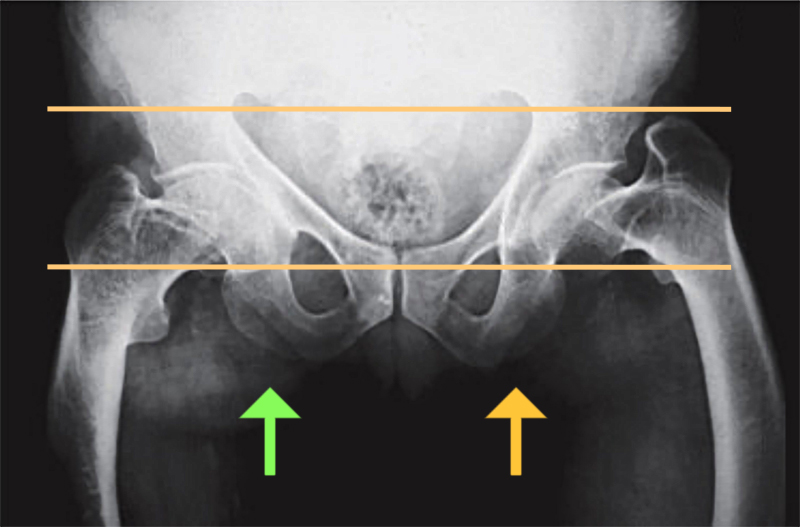 Osteomalacia deformity