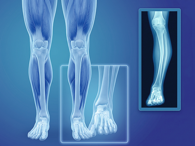 Paget's Bone Disease