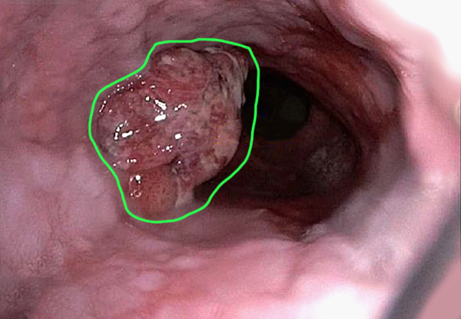 esophageal cancer