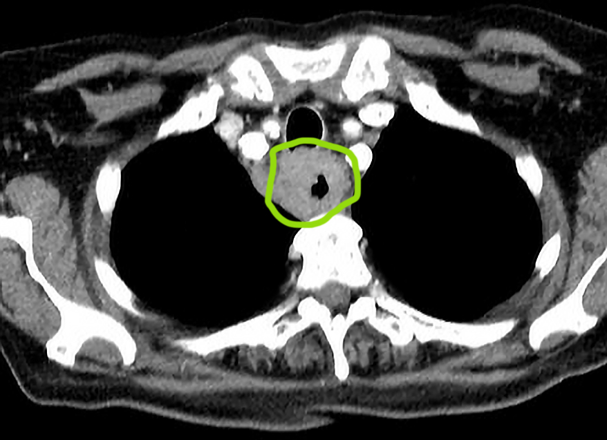 CT scan - esohageal cancer