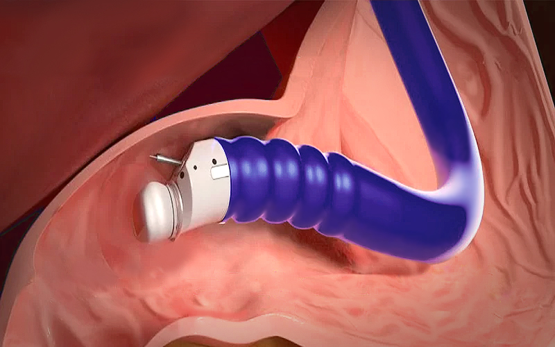 Endoscopic ultrasound