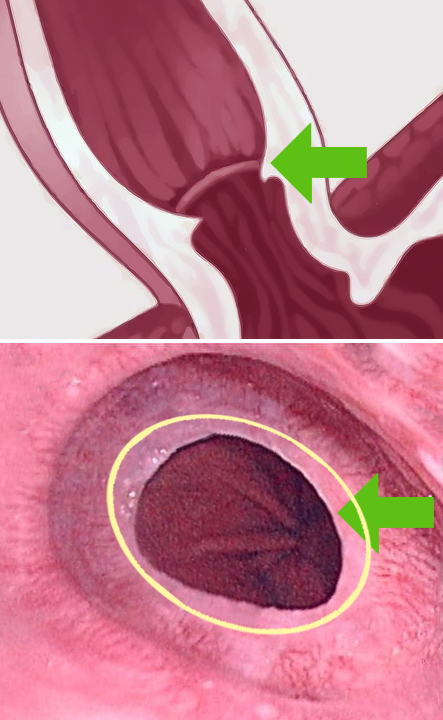 Schatzkis ring - esophageal disease