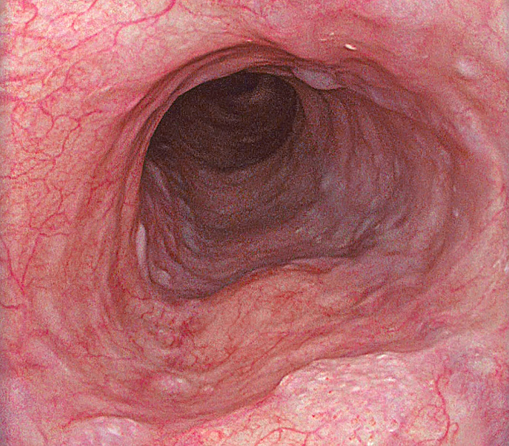benign esophageal disease - Saint John's Cancer Institute